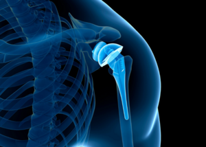 Shoulder Replacement Surgery: Key Insights | Dr. Mayank Pathak